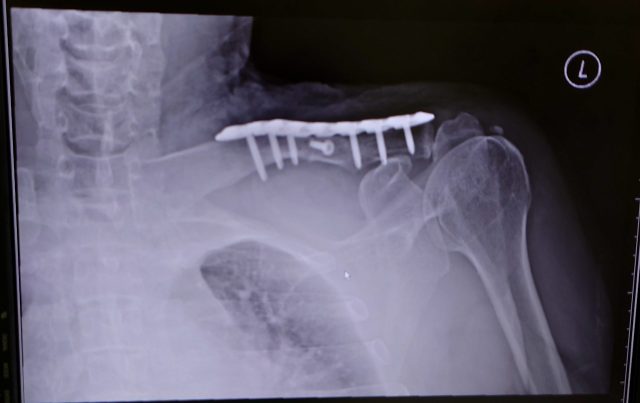 鎖骨骨折　プレート　手術後　レントゲン写真